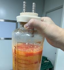 资阳水动力吸脂手术要做多久？